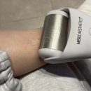 톡스앤필의원 전주점 | 톡스앤필 광주점 문신제거 1회차, 사후관리법 기록