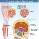 구획 증후군(Compartment syndrome)