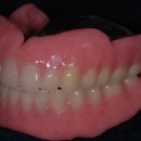 총의치[Complete denture] 이미지