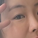 백피부과의원 | 여의도 유스피부과 눈밑꺼짐 리쥬란보다 부드러운 리즈네 시술과 LDM으로 해결한 후기 가격 및 통증