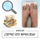 성모류마내과의원 | 통풍 초기 증상 다치지 않았는데 느껴지는 뻐근함일 수 있습니다