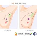 유방암의 치료 방법 이미지