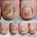 (주)메디컬글로우 | 마곡동네일샵 풋글로우 마곡 내성.무좀발톱.발각질.발관리.패디플래닝 위치