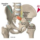 내다리 더 찢기(Q factor)/(와셔삽입방법) 이미지