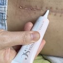 스마트에스씨 | 수술후 흉터연고 더마에스씨겔 비후성반흔 실리콘연고 후기