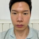 덕인한의원 | 노원역 한의원에서 깊은 이마 주름 여드름흉터 제거하기. 새살침 치료 1회차 후기.