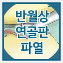 반월상연골판파열의 증상과 치료방법인 관절내시경에 대해 알아보자!!! 이미지