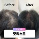 씨유오드리점 | 강남 압구정 닷티스트 정수리 가르마 smp 두피 문신 후기: 탈모 고민 끝