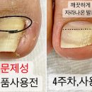 시점 민락점 | 병원에서 내성발톱 제거했는데 또 아파요... 통증·염증·재발 원인과 케어 방법[의정부 민락2지구]