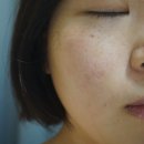 대전 여드름 관리 용두동 피부관리 미썸에서 더라포닝 관리 받은 후기