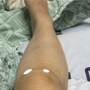 추 모 재 | ㅂ…반월상 연골 파열 수술 후기.. 제 2탄..(?)😢😩
