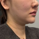 (주)팻라인 | 브이라인주사 팻제로주사 선릉역 피부과 이중턱개선 및 턱선 정리 효과 내돈내산 솔직후기