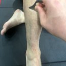 가동여자 | [안산 본오동 재활운동] 십자인대 수술 후 pt 1회 후 가동범위 증가 후기