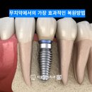 열린치과기공소 네이버블로그