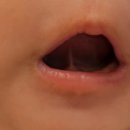 신익순 소아청소년과의원 | 2개월 아기 설소대수술 시술 후기_신익순소아청소년과의원(예약 및 준비물), 보험금청구