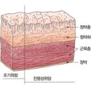 조기위암 Early Gastric Cancer 이미지