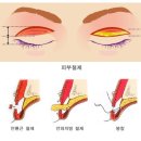 리뷰 ; 분당성형외과 - 쌍꺼풀수술법의 종류 (내 눈에 맞는 쌍꺼풀 찾기!) 이미지