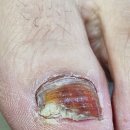 서원메디칼 | 발이 가벼워진 날, 청주발관리 ‘메디컬풋케어 두꺼운발톱 발각질 내성무좀발톱’ 솔직 후기