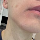 더젠틀호텔 | 수지피부과 젠틀맥스프로플러스효과 남자레이저제모 6차