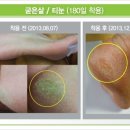 손태석 발가락운동용구 이미지