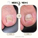 마디탄탄병원 | [울산중구내성발톱]체중 부담으로 눌린 내성발톱, 울산 베리굿케어에서 교정 성공후기✨