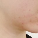 비브이의원 | 압구정로데오 '닥터손유나의원'에서 브이캣주사 2회차 후기