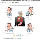 위식도 역류질환(gastroesophageal reflux disease) 이미지