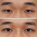 가미성형외과의원 | 남자눈성형, 자연스러움을 중요시! (쌍꺼풀수술+눈매교정)