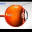 황반변성을 부추기는 청색광을 조심하세요 이미지