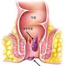 치질 원인과 종류 증상 치루, 치핵, 치열의 차이점 예방 방법 이미지