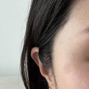 30대 흑자제거 후기2