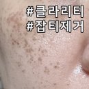 샤인약국 | 성남피부과 기미잡티제거 클라리티 레이저 후기