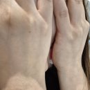 미사메디컬약국 | 양쪽 콩다래끼 한번에 짼 후기.. | 미사역 연세봄안과 | 콩다래끼 째기 수술