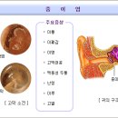 중이염 이미지