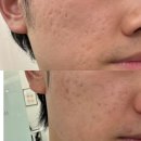 자연드림한의원 | [강남한의원] 아이스픽, 박스카 여드름흉터 새살침 3회차 내돈내산 후기✨ 가격, 통증, 다운타임, 관리법...