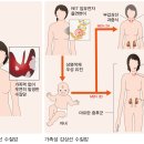 갑상선 수질암 이미지