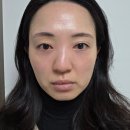 진메드 | 은평구피부과 통증 없는 리프팅 연신내 레비나스와 바쿠메드 후기