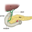 바터 팽대부 암 AOV Cancer(Ampullar Of Vater Cancer) 이미지