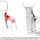 2. 고개가 뻣뻣한 견갑거근의 통증 이미지