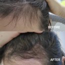 강동-천호-2438 | 천호역에서 가까운 미작뷰티 천호 헤어라인 반영구 후기