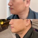 브이맨 | 방배동피부과 브이맨 달걀주사 남자 윤곽주사 턱살빼기 효과 전후 후기