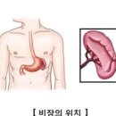 비장 위치 기능, 비장비대증 원인 증상 통증 검사 치료 간략정리 이미지