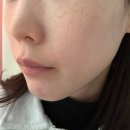 폼의원 | 우유빛의원 리쥬란힐러 후기｜써마지·잡티레이저까지 한 번에 받아본 솔직 후기