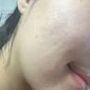 필앤필의원 | 톡스앤필 건대점 내돈내산 후기 (포텐자, 쥬베룩, 리쥬란힐러, 턱 보톡스)