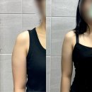 신사역365 약국 | 신사역 팔뚝 지방추출주사 지팻주사 가격 비포 애프터