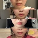 강남역 울쎄라 대신 받은 브이로 리프팅 가격 및 통증 붓기 전 후!