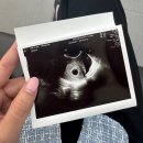 선보약국 | [임신기록] 5주차/임테기 두줄 확인 후 아기집확인, 초기증상, 물품구입 및 검진비용 총정리(임밍아웃...