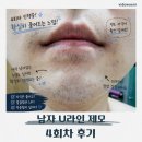U-4 | 창원 마산 남자 수염 레이저제모 4회차 내돈내산 후기｜U라인 + 목 제모 효과 체감