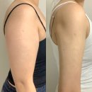 도성카병원샤워 | 인천팔뚝지방흡입 부평다이어트병원 카복시받고 온 진짜후기 전후비교