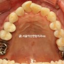이심는연합치과의원 | 서울아산연합 치과 치주염으로 인한 골소실, 발치 후 하악 임플란트 브릿지로 개선까지